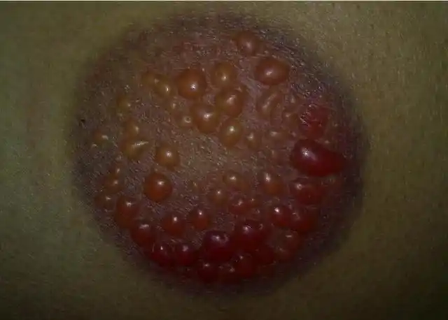 拔罐后的罐印长这样说明你有病拔罐对身体有什么好处