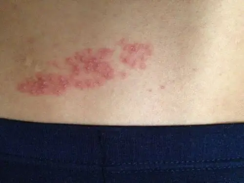 腰部起红点,不痛不痒,然后只是腰部有一点,其他地方正常,这是怎么搞的