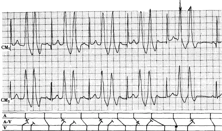 医学 心律失常 正文 【心电图特征】 室性早搏隐匿传导引起其后窦性p
