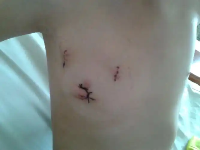 胸腔镜心脏手术微创刀口 - 好大夫在线