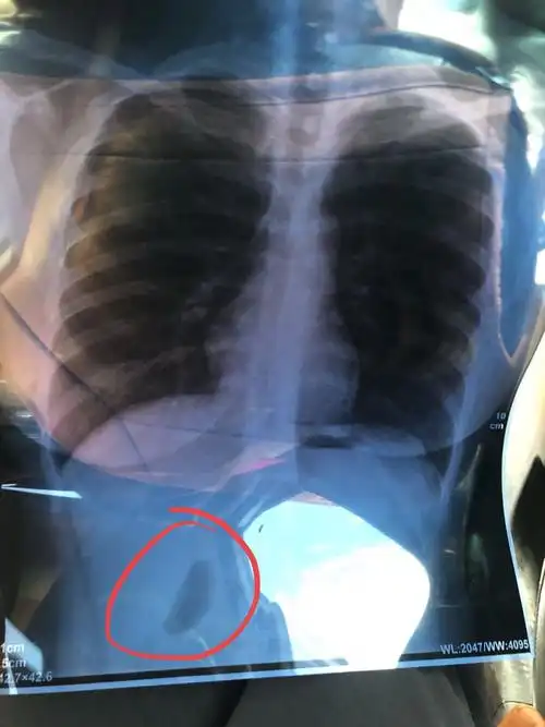 胸片正位下方阴影是什么