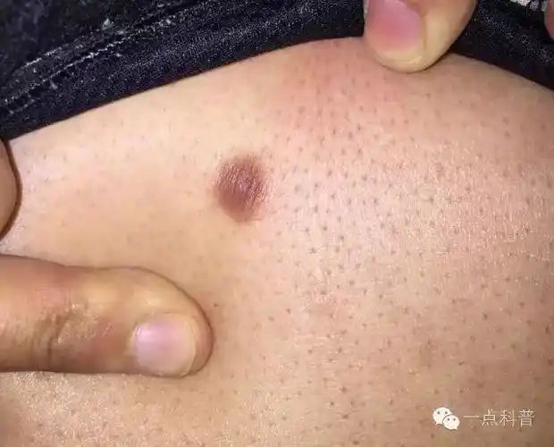 腿上长了个特别硬的疙瘩是瘤吗会癌变吗