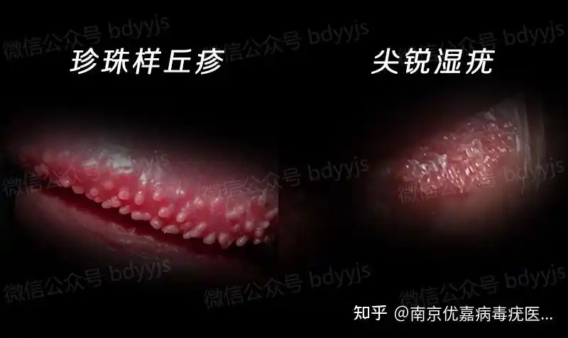 尖疣早期和珍珠疹图片