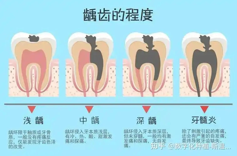 龋齿(蛀牙)的问题困扰的不仅仅是儿童,青少年等,成年人同样有这这方面