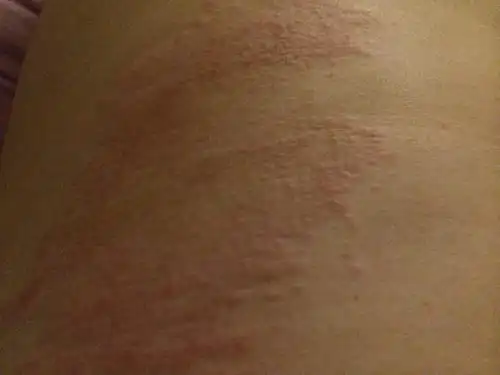 左腰上长这种红苞会痒,但是我没怎么去扣,最近一直