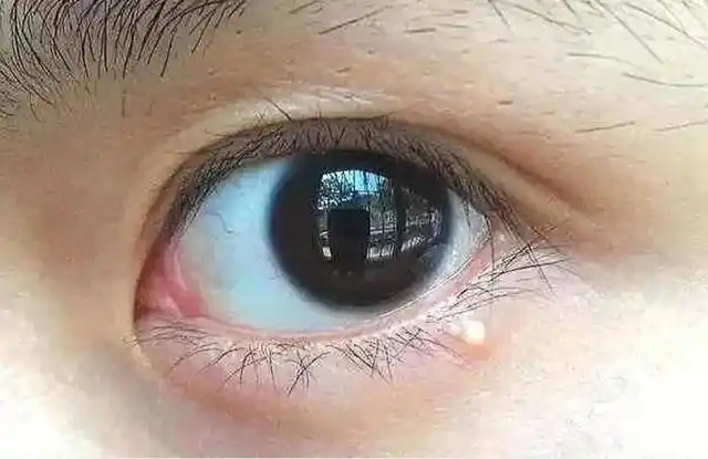 眼周长脂肪粒是不是因为护肤品太过营养呢?