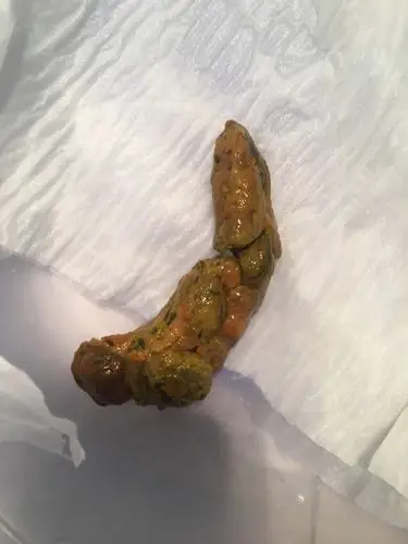 胃一直消化不怎么好以前年做胃镜慢性浅表性胃炎.因为做胃镜太难受.所