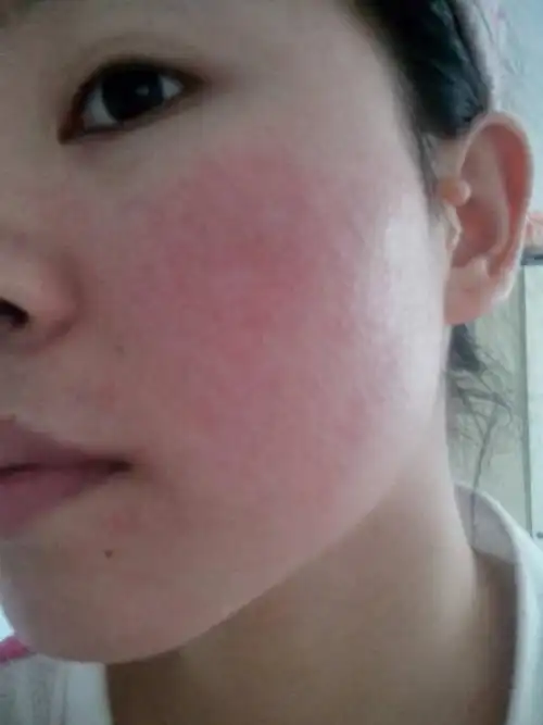 月经后皮肤过敏起皮