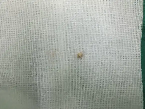 右侧颌下腺导管结石,ct片可见结石位于下颌第二磨牙后,腺体实质处.