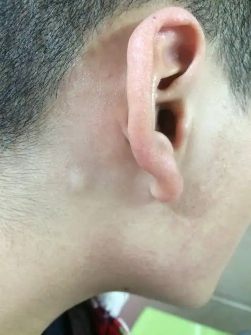 粉瘤 有时候周围会痒 偶尔会胀胀的 熬夜会变大吗 有必要手术吗 还是