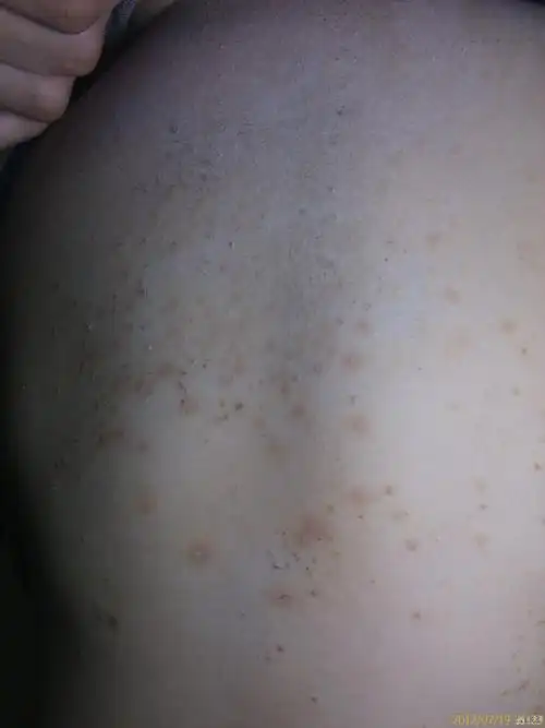 看图识病马拉色菌毛囊炎三天治愈