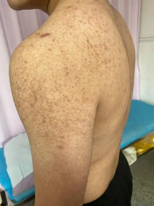 或者 者  为你 解答,鸡皮肤又称为毛周角化病,是一种  毛孔 漏斗角化