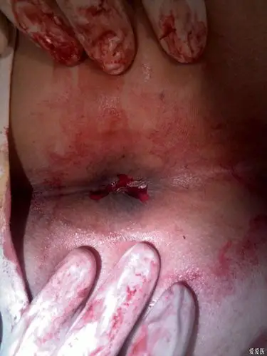 混合痔术前术后照片 - 肛肠外科讨论版 - 爱爱医医学论坛