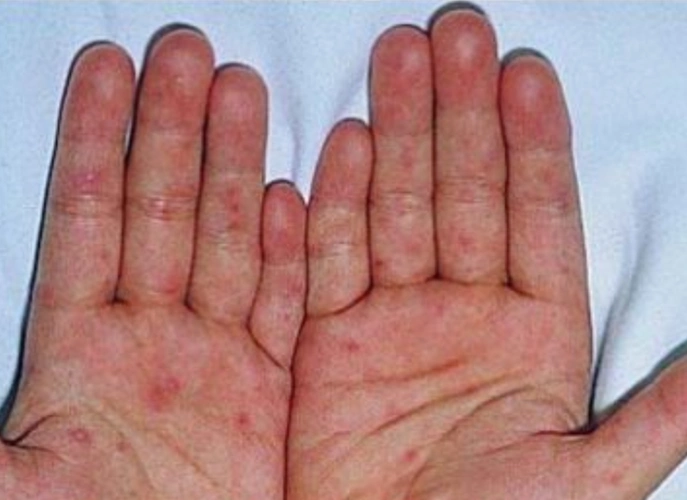 艾滋病舌部图片