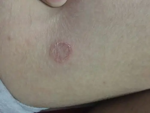 我大腿内侧有一个红斑之前是小的后来变大了上面还脱皮应该有1个