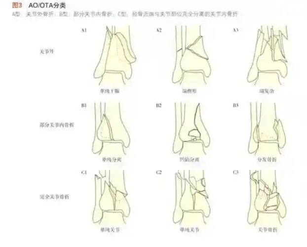 骨科医生的挑战特殊类型踝关节骨折(pilon骨折)