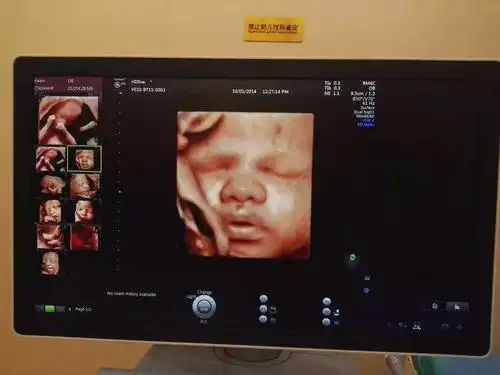 怀孕28周的准妈妈做完四维产检痛哭流涕,胎儿确诊畸形,后悔莫及