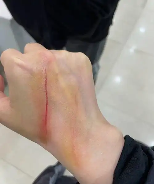 徐冬冬发文晒受伤照粉丝抱怨这弟弟一点也不知道怜香惜玉