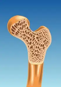 股骨矩阵多彩的骨质疏松症计划照片