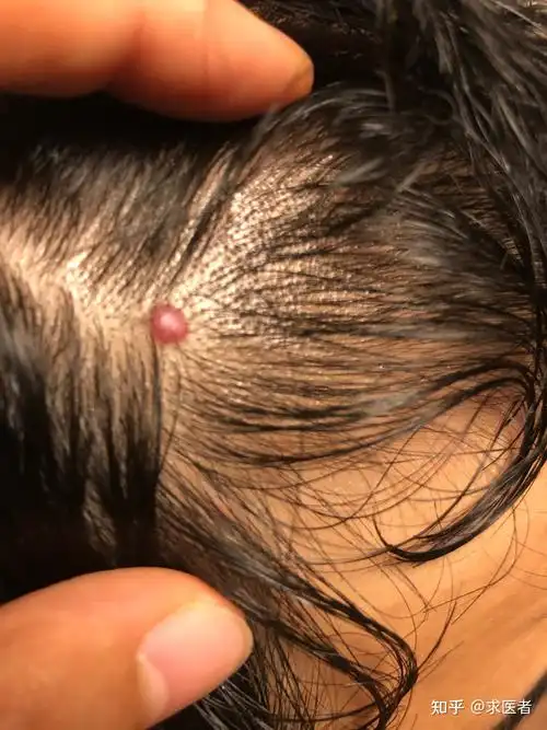 头上长了个红色的肉疙瘩 - 知乎