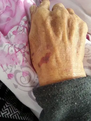 老人手上张红色斑 一块一块的 还有点像淤血 有图片 怎么回事