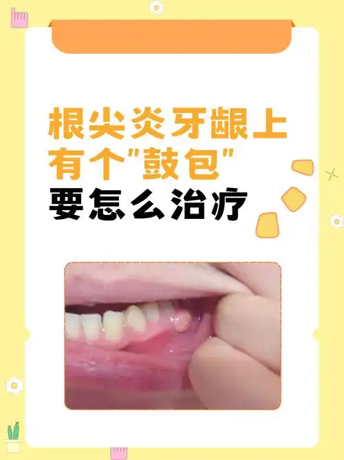 根尖炎牙龈上有个"鼓包",要怎么治疗