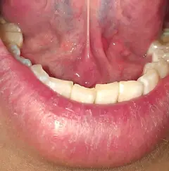 舌头下面,与下颚的连接处,有多个红色的小疙瘩