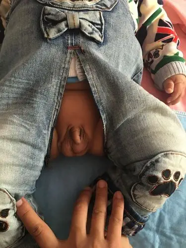 这是小儿疝气吗?