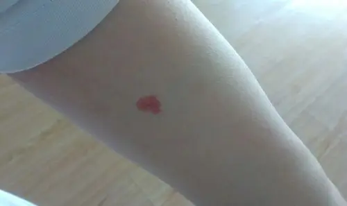 胳膊胎记可以算命吗