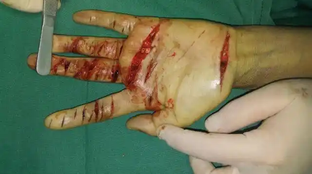 女子砍自己左手十几刀,三十多个口子,缝了上百针.