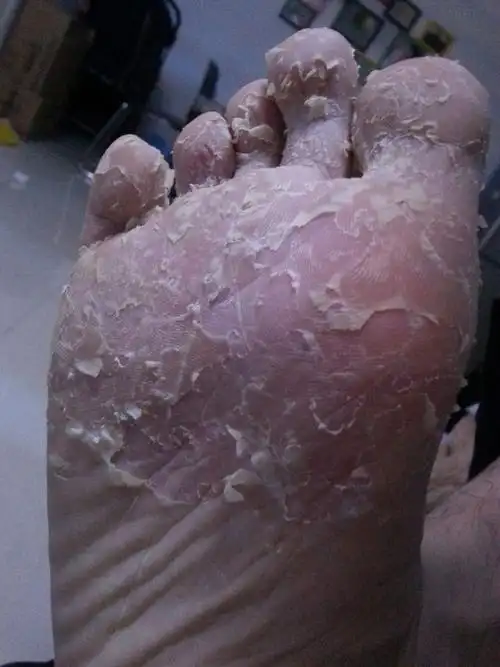 双脚一直掉皮,别人都说我有脚气,但是不疼不痒.