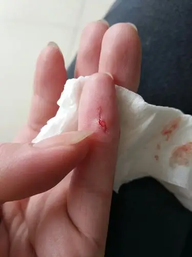 被猫咬了,医生说打三针狂犬疫苗就行了,会不会不够,看网上说要打血清