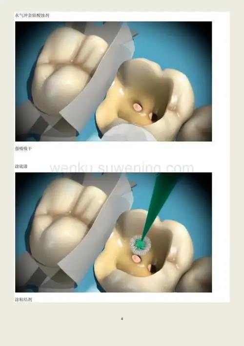 根管治疗后高嵌体修复