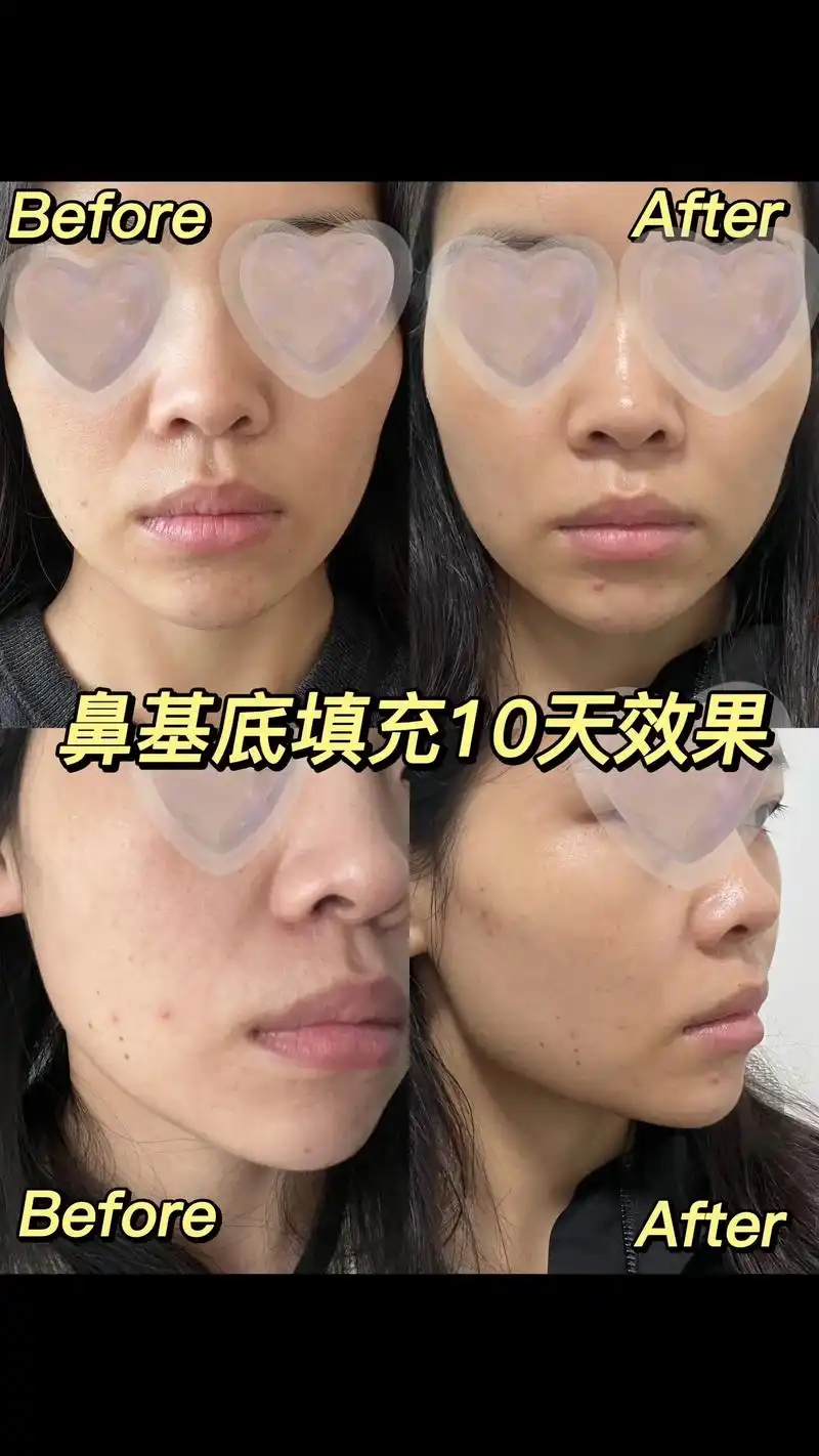 原相机分享鼻基底填充10天效果~塌鼻救星.我做完玻尿酸填充鼻 - 抖音