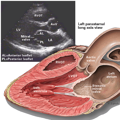 【共享】心脏超声经典图片
