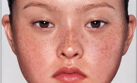 2块钱一管的红霉素软膏,可以淡化斑点?是真是假?医生道出实情