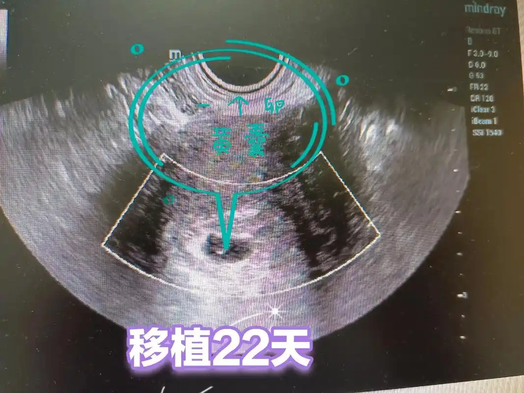 试管三代囊胚分裂的单绒双羊均太停了.女,35岁,移植第三代囊 - 抖音