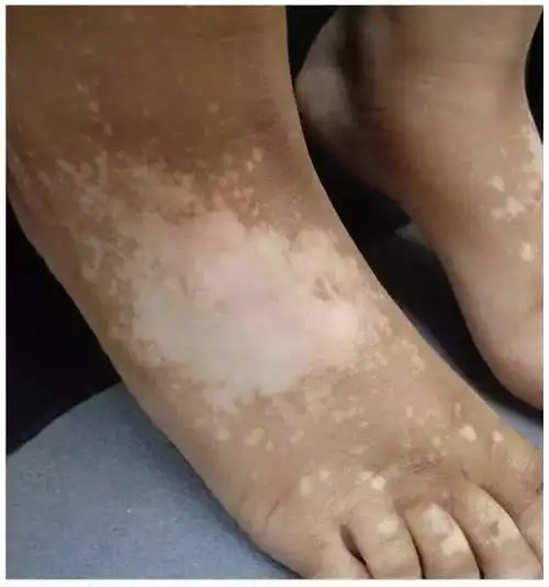 白癜风发病机制及分类新发现(二)