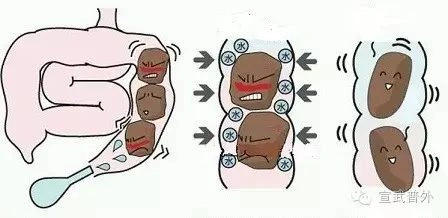 如何正确使用开塞露? (原创)