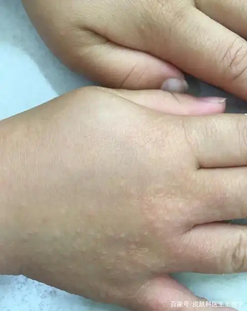 小儿沙土皮炎的防治措施