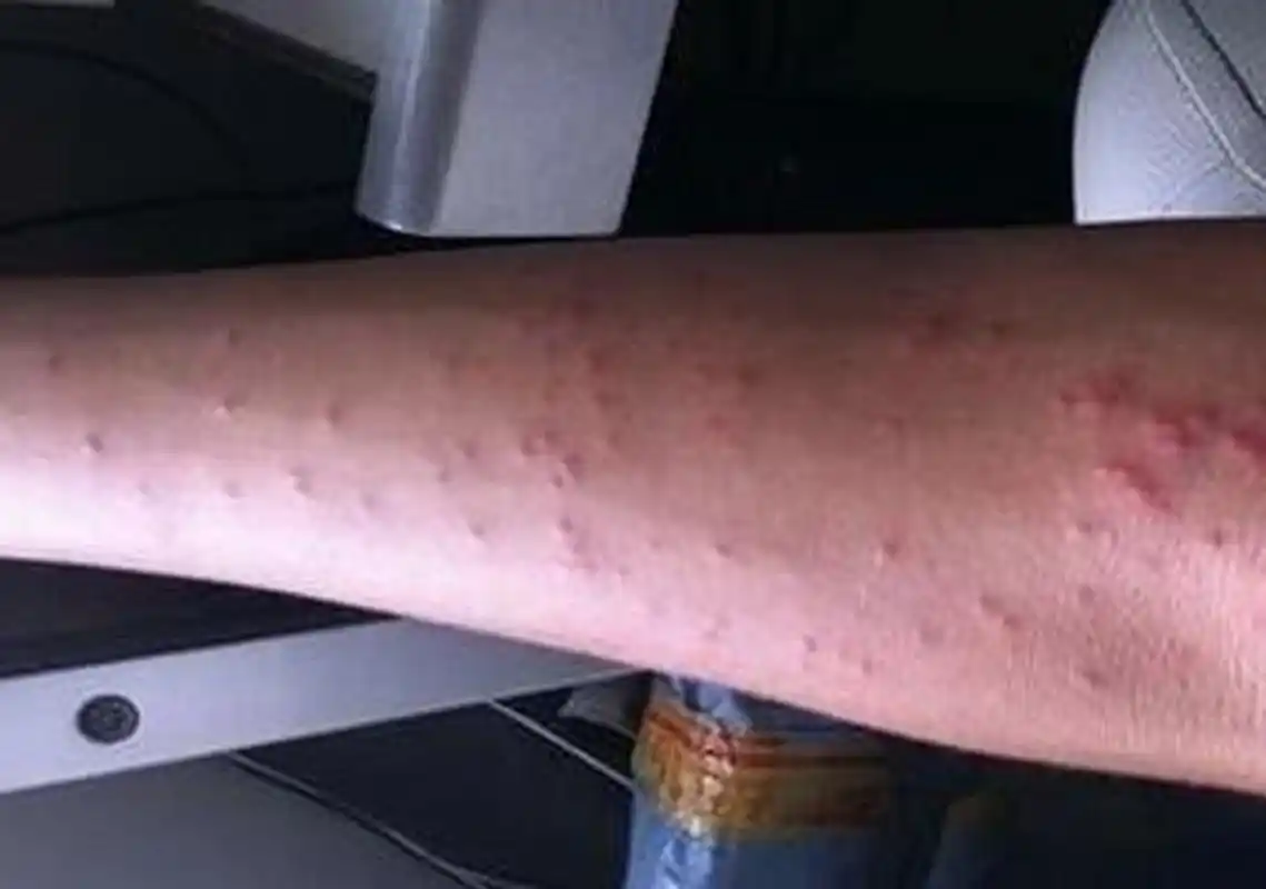 如何区分荨麻疹和湿疹 那么有很多人啊,可能是得了一些皮肤过敏性疾病