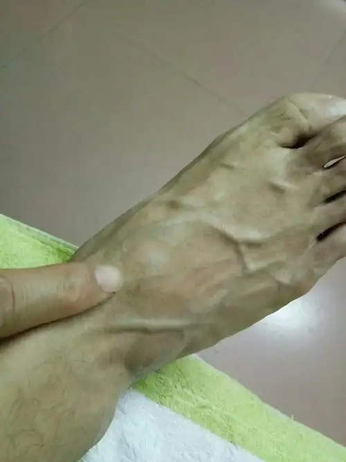 脚背上长了个肉瘤一两年,今天发现肉瘤消了,怎么回事?