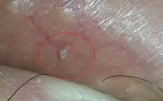 睾丸表皮凸起的小肉粒