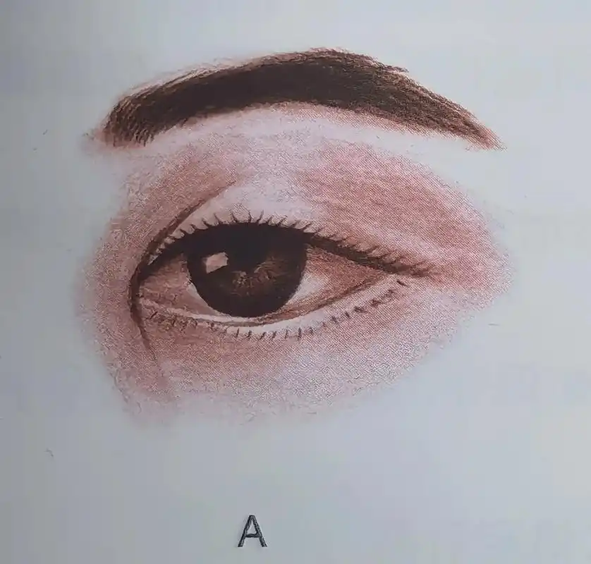 内眼角分类及手术方法.今天继续和大家分享内眦赘皮问题.