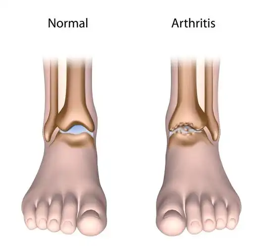 透明质酸和其他保守方法治疗踝关节骨关节炎:可有条件地推荐使用透明
