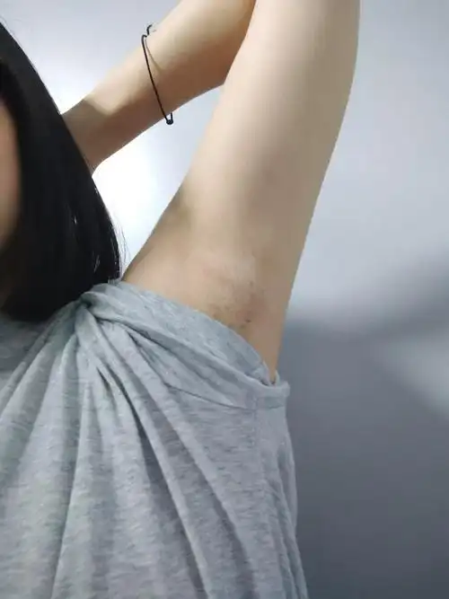 这样子是淋巴结肿大吗更新医生说是副乳淋巴结不会这么大