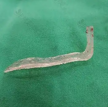 朝天鼻修复 鼻机能改善术前:隆鼻假体排异成朝天鼻,漏鼻孔,鼻子左右不