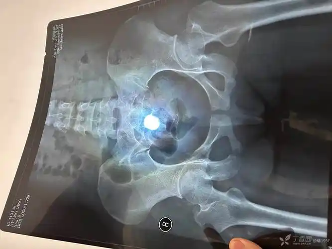 右侧耻骨上下支骨折51天