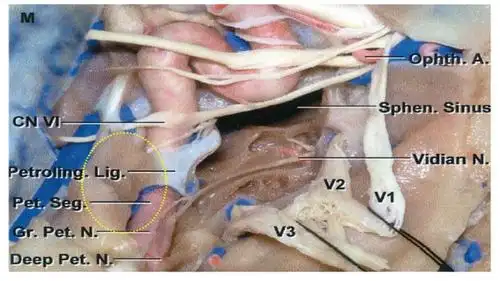 岩舌韧带延长线后方,岩浅大神经内前方,此区域(黄色虚线圈所示)为岩尖