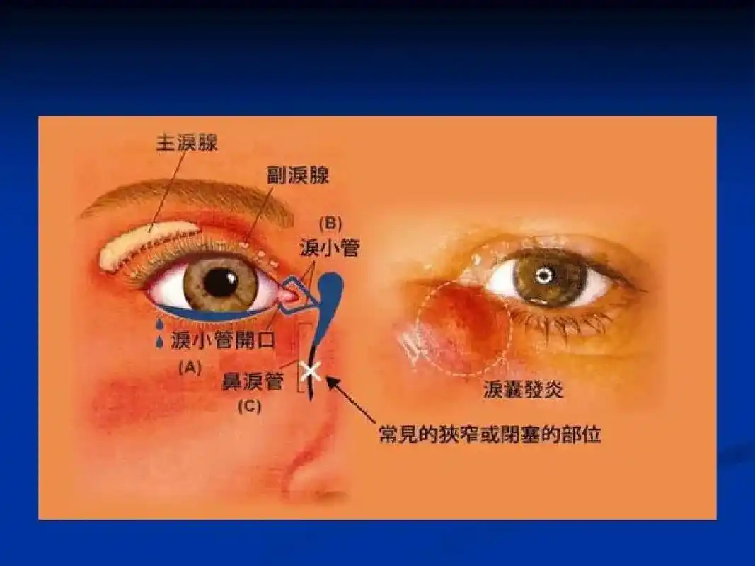 慢性泪囊炎手术#医学科普 #微创手术 #医学科普仅供参考如有 - 抖音